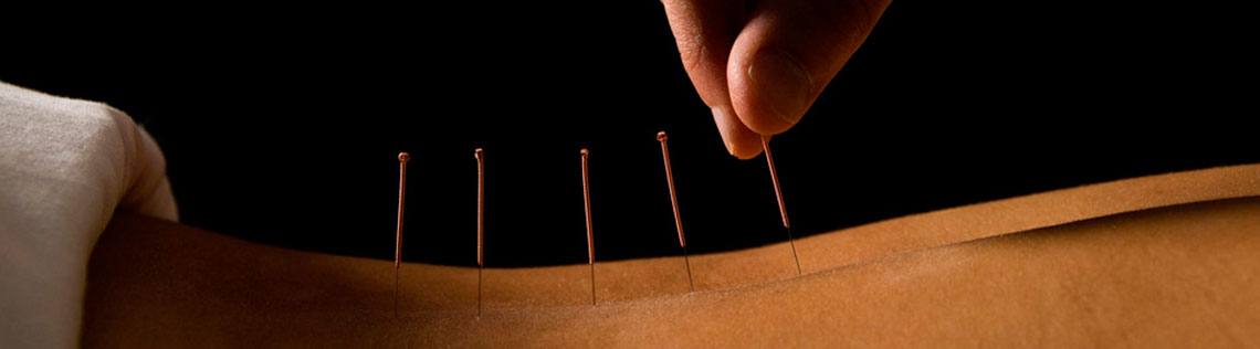 Acupuncture treatment - close-up of needles on skin