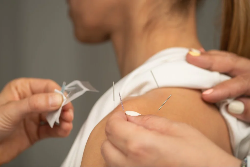 Acupuncture needles being placed in a patient's shoulder